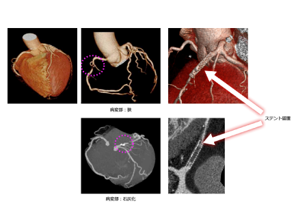 心臓CT検査でわかること